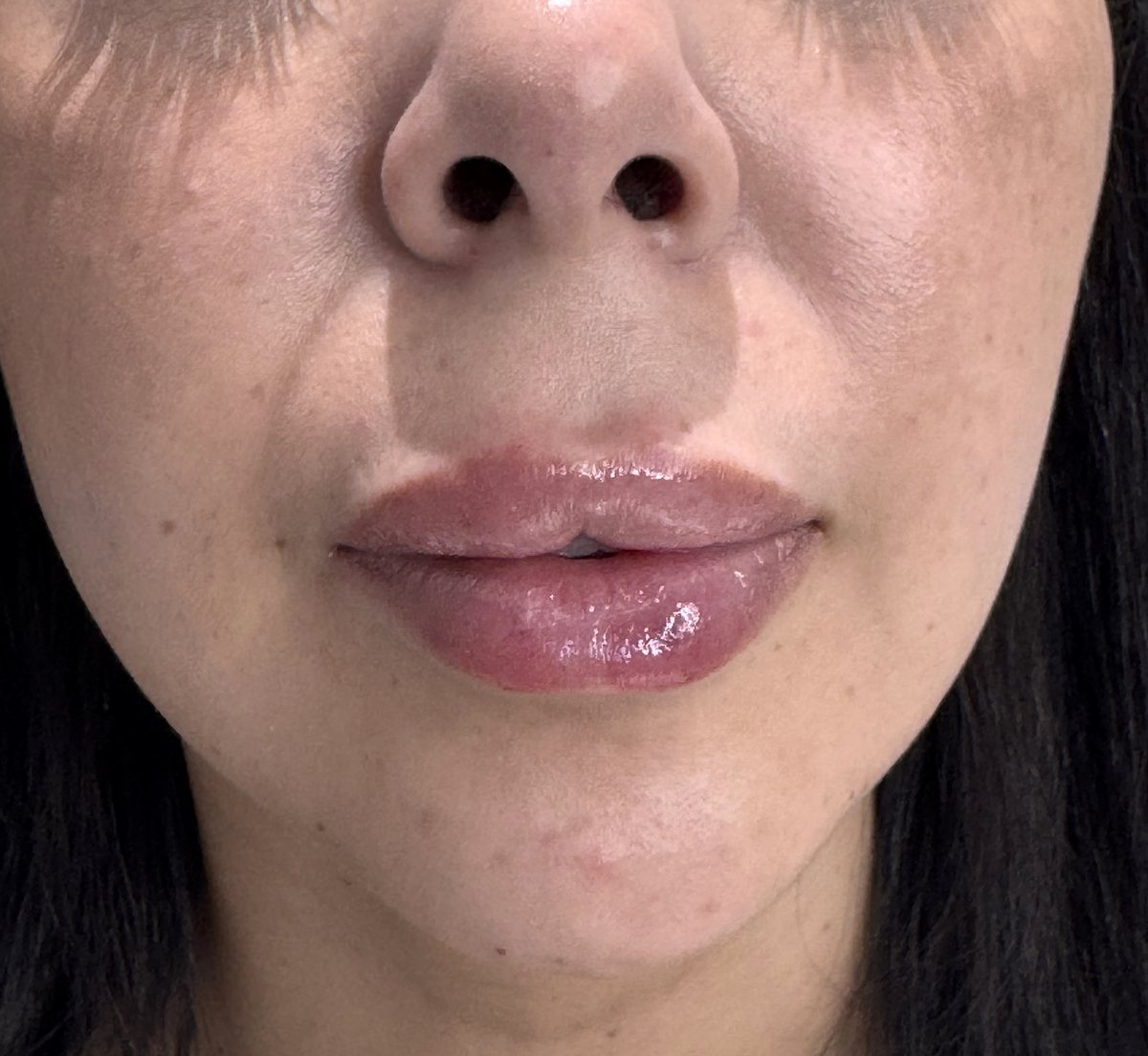 Lips after hyaluronic acid filler, close-up