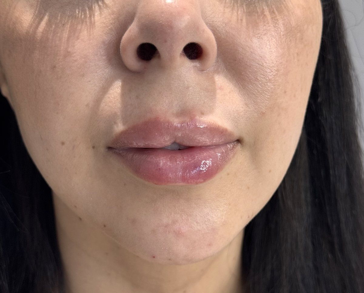 Lips after hyaluronic acid filler, front view