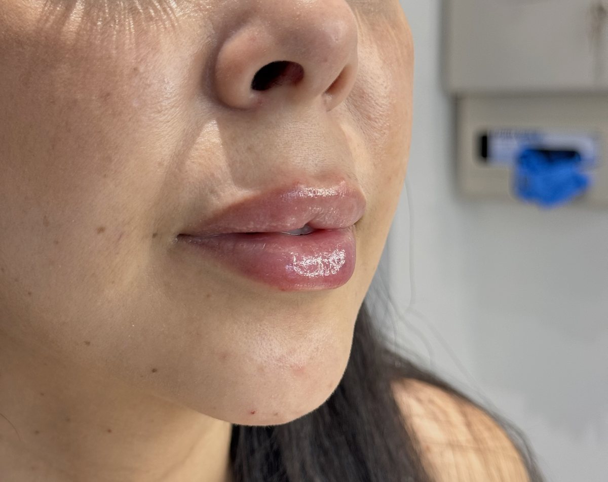 Lips after hyaluronic acid filler, side view